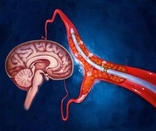 “腦?！痹絹碓蕉?？多半都是“拖”出來的，有這4種征兆趕緊去就醫(yī)?。? /></a></div>
                                <div   id=