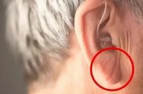 耳朵傷的折痕就能看出心臟??？猝死為什么越來越年輕化？