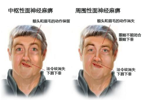“面癱”不僅不酷，并且需要治療