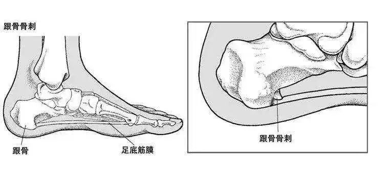 骨刺不是病？切勿過度治療！