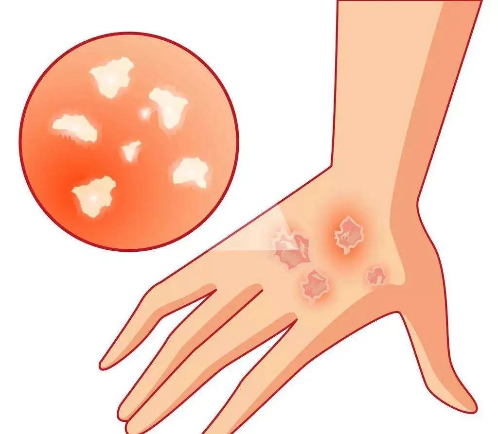 開在皮膚上的“花”？謹(jǐn)防春季玫瑰糠疹