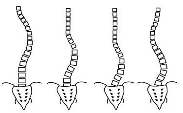 脊柱側(cè)彎如何康復(fù)？河南省中醫(yī)院西區(qū)醫(yī)院專家這樣說
