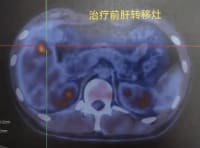 年輕小伙癌癥晚期！這些習慣不少人有，醫(yī)生：別忽視——