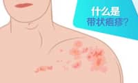 這種病不致命，疼起來卻要人命！關(guān)注帶狀皰疹，及早預(yù)防……
